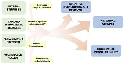 Asymptomatic Carotid Disease and Cognitive Impairment: What Is the Evidence?